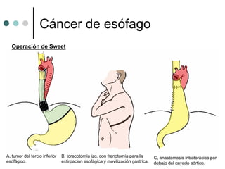 Cáncer de esófago
  Operación de Sweet




A, tumor del tercio inferior   B, toracotomía izq. con frenotomía para la       C, anastomosis intratorácica por
esofágico.                     extirpación esofágica y movilización gástrica.   debajo del cayado aórtico.
 