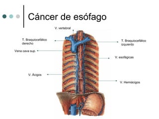 Cáncer de esófago
                         V. vertebral


    T. Braquiocefálico                      T. Braquiocefálico
    derecho                                 izquierdo

Vena cava sup.

                                        V. esofágicas




         V. Ácigos

                                           V. Hemiácigos
 