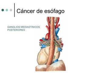 Cáncer de esófago

GANGLIOS MEDIASTÍNICOS
POSTERIORES
 