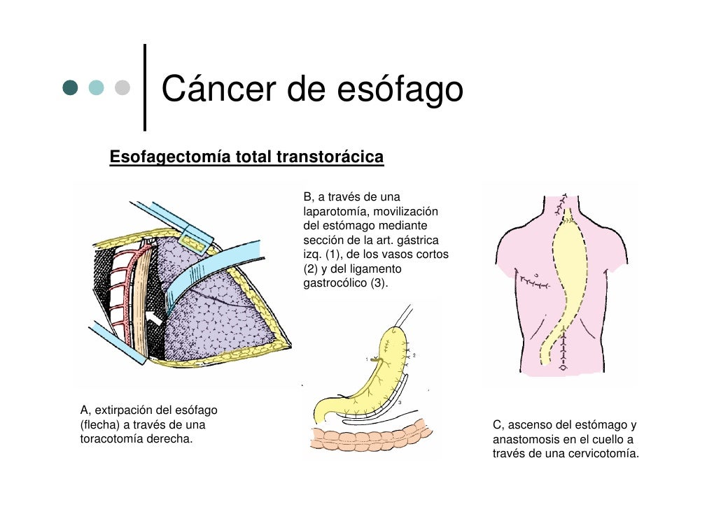Cancer De Esofago