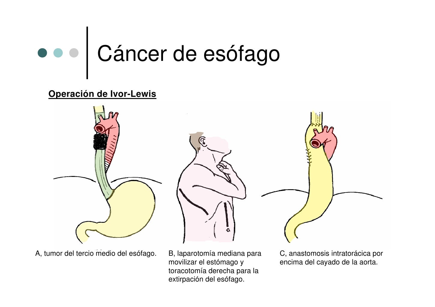 Cancer De Esofago