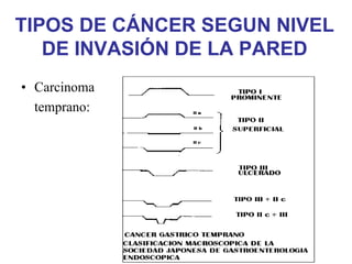 TIPOS DE CÁNCER SEGUN NIVEL
   DE INVASIÓN DE LA PARED
• Carcinoma
  temprano:
 