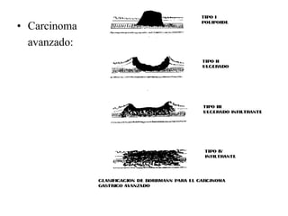 • Carcinoma
  avanzado:
 