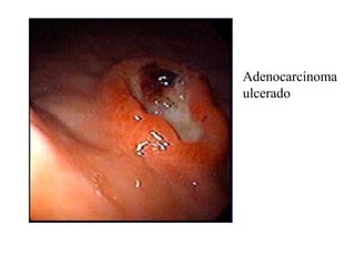 Adenocarcinoma
ulcerado
 