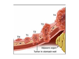 Cancer de estómago