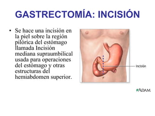 GASTRECTOMÍA: INCISIÓN
• Se hace una incisión en
  la piel sobre la región
  pilórica del estómago
  llamada Incisión
  mediana supraumbilical
  usada para operaciones
  del estómago y otras
  estructuras del
  hemiabdomen superior.
 