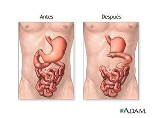 Cancer de estómago