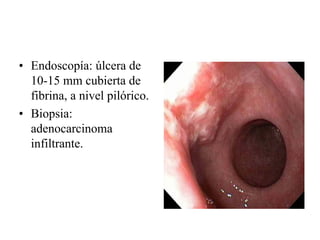 • Endoscopía: úlcera de
  10-15 mm cubierta de
  fibrina, a nivel pilórico.
• Biopsia:
  adenocarcinoma
  infiltrante.
 