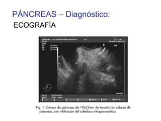 PÁNCREAS – Diagnóstico:
ECOGRAFÍA
 