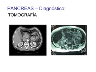 PÁNCREAS – Diagnóstico:
TOMOGRAFÍA
 