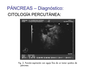 PÁNCREAS – Diagnóstico:
CITOLOGÍA PERCUTÁNEA:
 