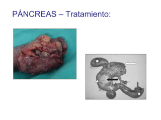 PÁNCREAS – Tratamiento:
 