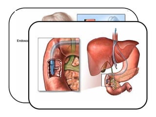 colangitis