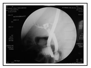 colangitis