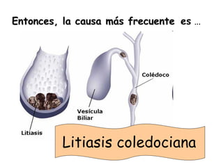 Entonces, la causa más frecuente es …




         Litiasis coledociana
 