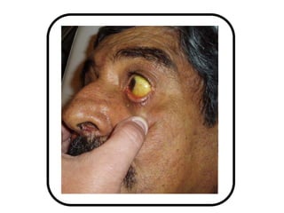 colangitis