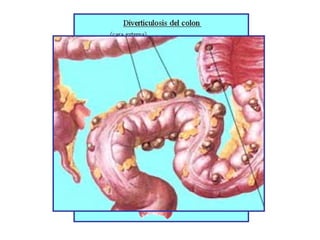 enfermedad diverticular
