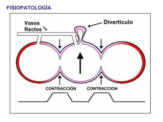 FISIOPATOLOGÍA

     Vasos                        Diverticulo
     Rectos




              CONTRACCIÓN   CONTRACCION
 