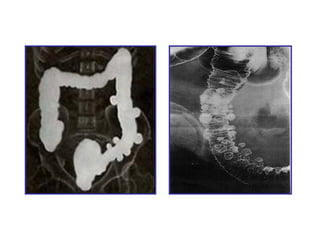 enfermedad diverticular