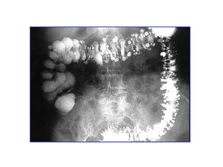enfermedad diverticular