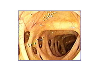 enfermedad diverticular