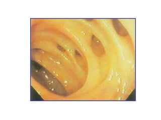 enfermedad diverticular