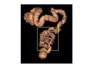 enfermedad diverticular