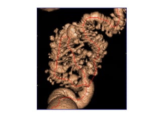 enfermedad diverticular