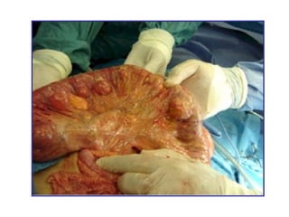 enfermedad diverticular