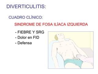 DIVERTICULITIS:

CUADRO CLÍNICO:
   SINDROME DE FOSA ILÍACA IZQUIERDA

   - FIEBRE Y SRG
   - Dolor en FID
   - Defensa
 