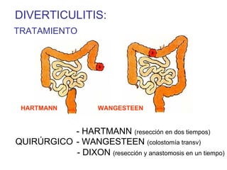 DIVERTICULITIS:
TRATAMIENTO




 HARTMANN             WANGESTEEN


           - HARTMANN (resección en dos tiempos)
QUIRÚRGICO - WANGESTEEN (colostomía transv)
           - DIXON (resección y anastomosis en un tiempo)
 