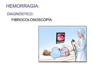 HEMORRAGIA:
DIAGNÓSTICO:
  FIBROCOLONOSCOPÍA
 