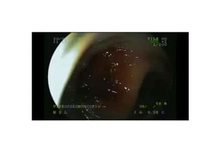 enfermedad diverticular