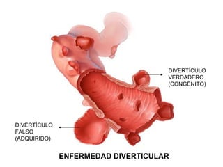 DIVERTÍCULO
                                    VERDADERO
                                    (CONGÉNITO)




DIVERTÍCULO
FALSO
(ADQUIRIDO)


              ENFERMEDAD DIVERTICULAR
 