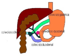 fistulas biliares