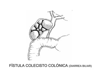 FÍSTULA COLECISTO COLÓNICA (DIARREA BILIAR)
 