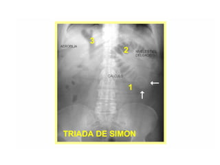 fistulas biliares