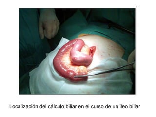 Localización del cálculo biliar en el curso de un ileo biliar
 