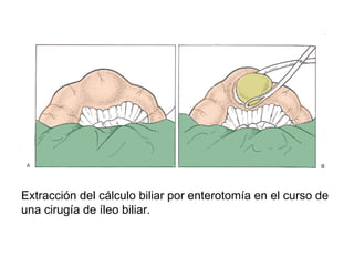 Extracción del cálculo biliar por enterotomía en el curso de
una cirugía de íleo biliar.
 