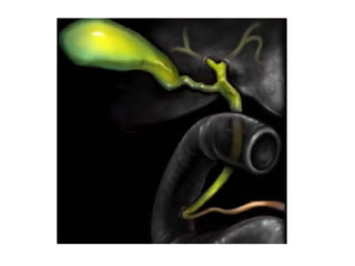 fistulas biliares