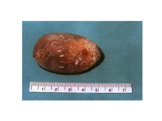 fistulas biliares