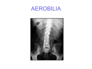 AEROBILIA
 