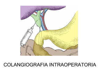 COLANGIOGRAFIA INTRAOPERATORIA
 