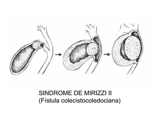 SINDROME DE MIRIZZI II
(Fístula colecistocoledociana)
 