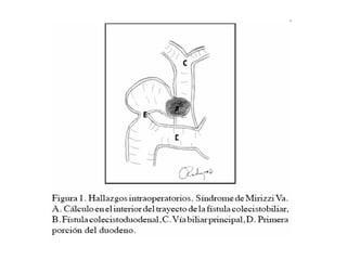 fistulas biliares