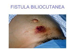 FISTULA BILIOCUTANEA
 