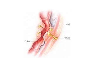 fistulas enterocutaneas