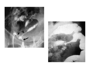 fistulas enterocutaneas
