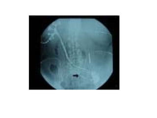 fistulas enterocutaneas