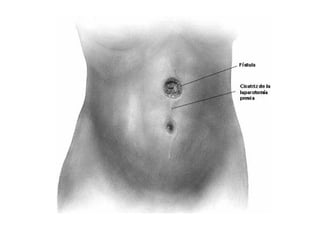 fistulas enterocutaneas